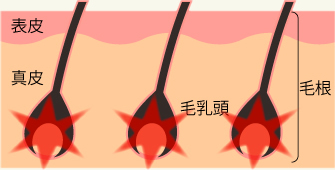 従来の脱毛機